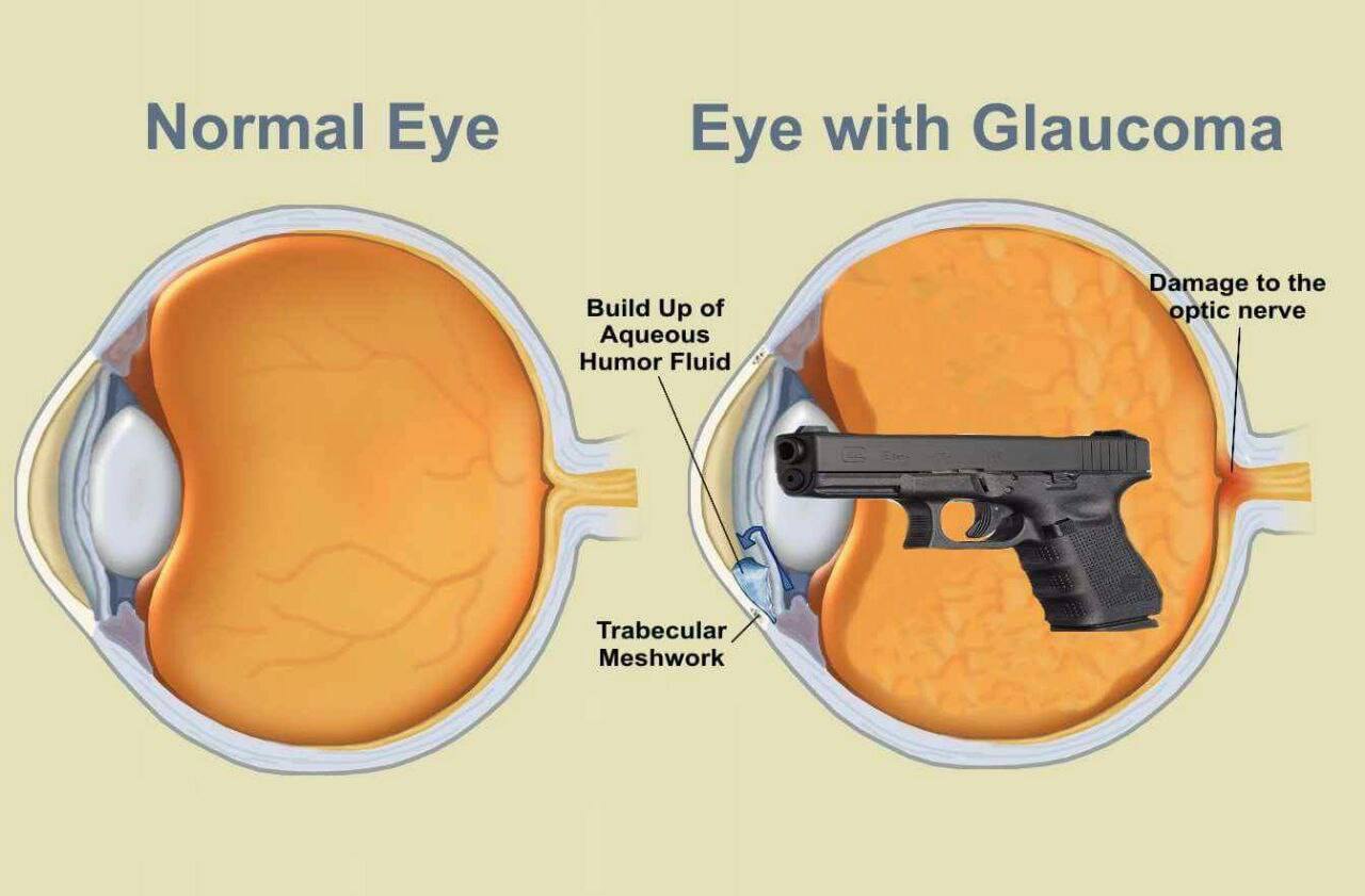 Eye With Glaucoma